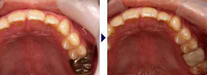 左上第一大臼歯のクラウン（銀歯）